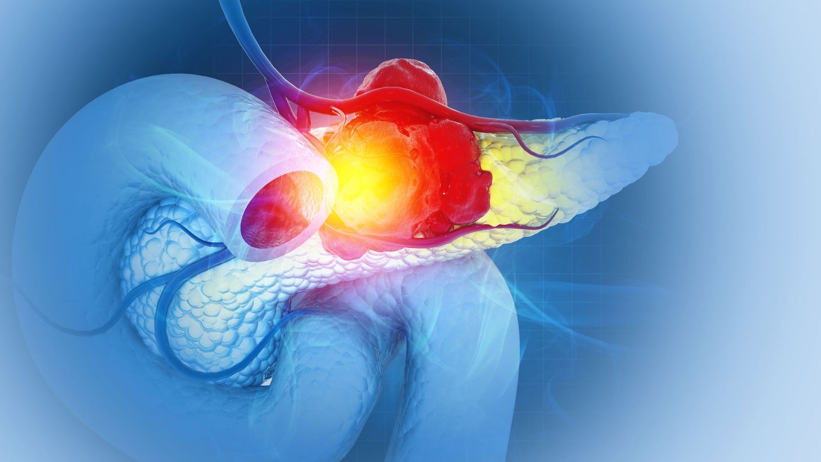 Microscopic view of pancreatic cancer cells