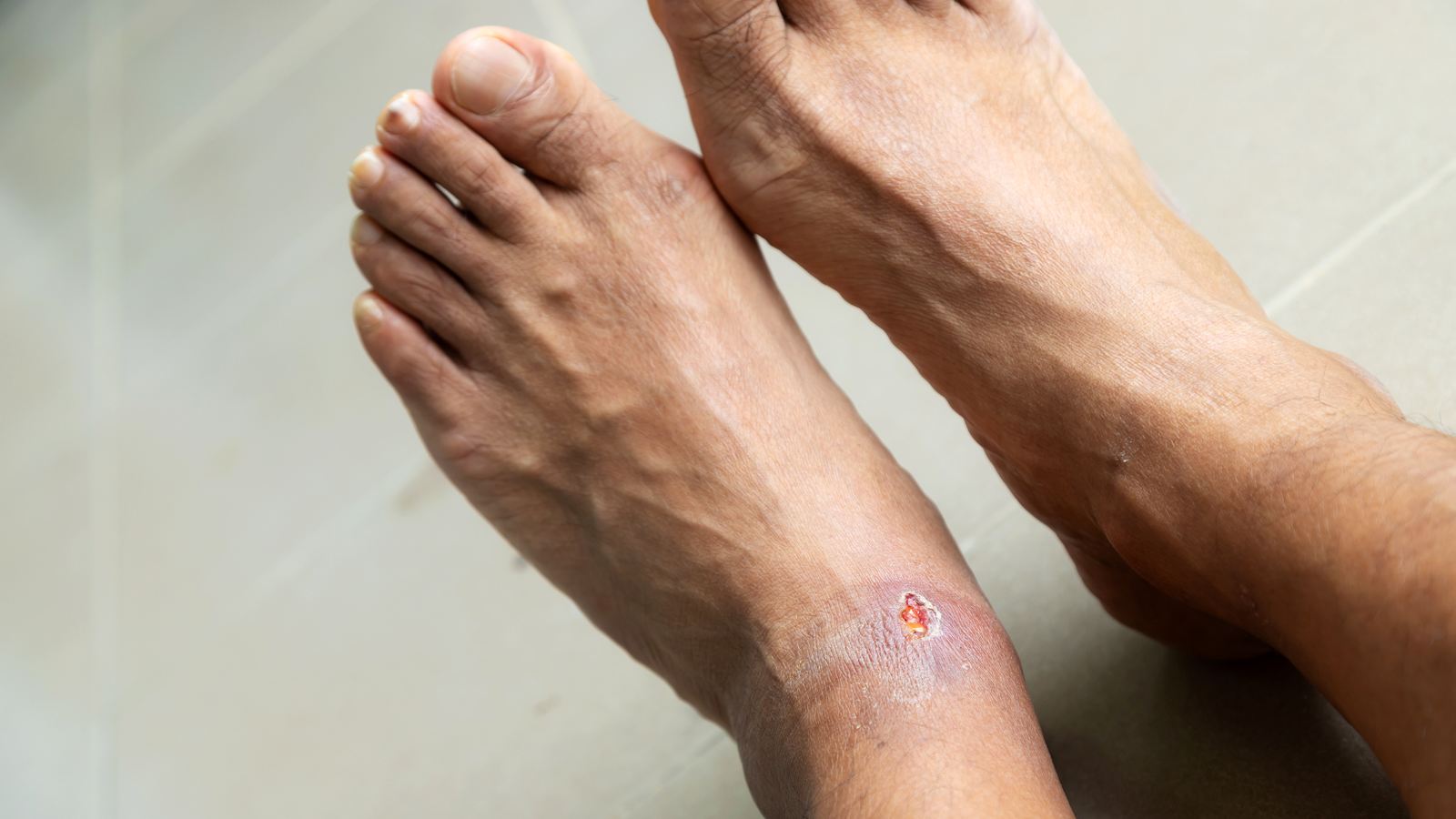 Diabetic Ulcer Inflammation