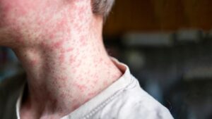 Texas Health Officials Intensify Efforts Amid Measles Outbreak