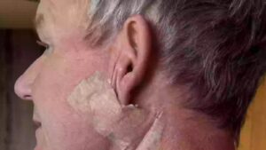 Gordon Ramsay Undergoes Surgery for Skin Cancer, Raises Awareness