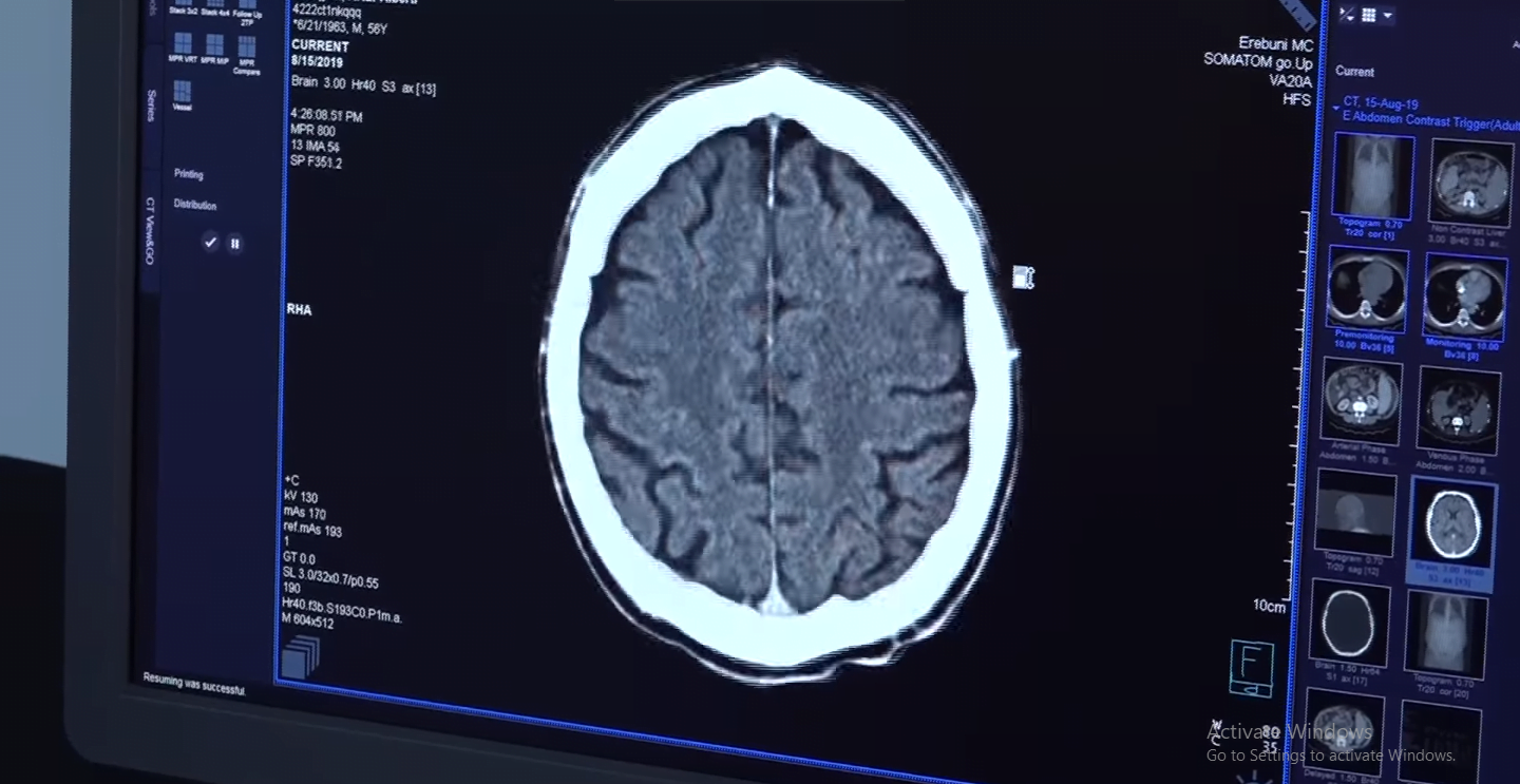 Գլխուղեղի սուր իշեմիկ կաթվածի ծրագրով անվճար բուժօգնություն է ստացել 180 քաղաքացի (ՏԵՍԱՆՅՈՒԹ)