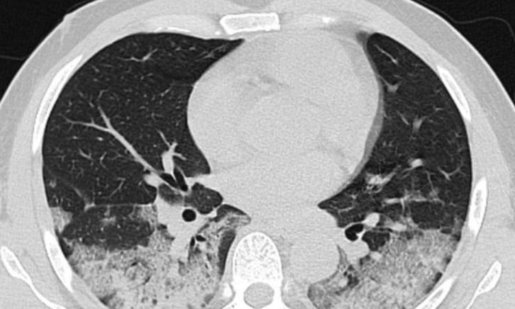 Ինչպե՞ս է կորոնավիրուսը «կլանում» պացիենտի թոքերը․ Baza