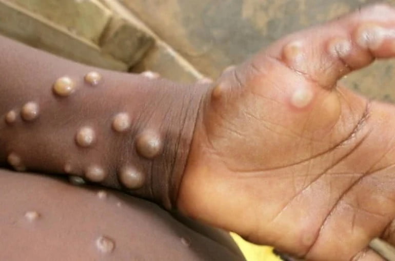 Ադրբեջանը դիմել է ԱՀԿ-ին՝ խնդրելով տրամադրել թեստեր՝ կապիկի ծաղիկի հայտնաբերման համար