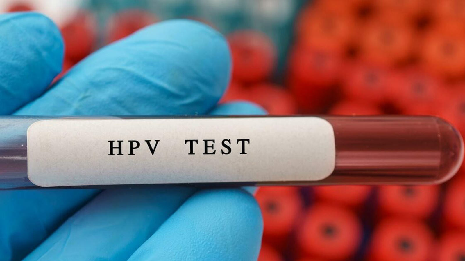 FDA-ն հաստատել է տնային HPV թեստը արգանդի վզիկի քաղցկեղի հայտնաբերման համար