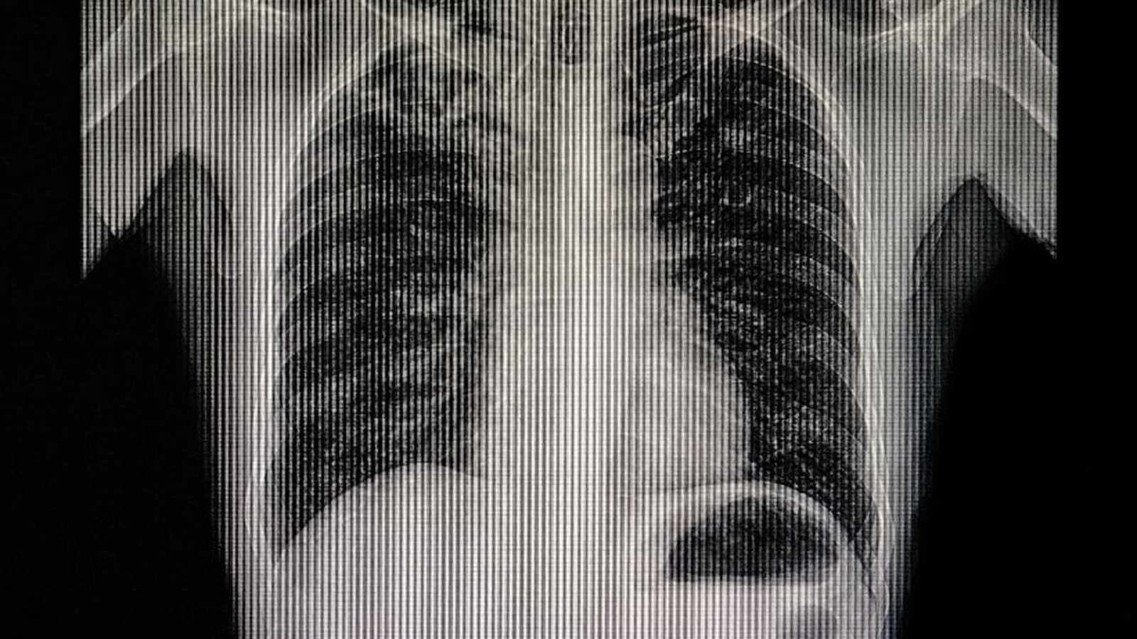Digital chest X-ray analysis display