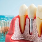 An anatomical model of teeth showing a titanium dental implant anchored in the jawbone